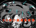 スキルス胃癌のCT診断は難しい　腹部CT