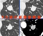 肺硬化性血管腫（type II pneumocytoma）　胸部CT