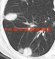 肺リウマチ結節　(Pulmonary Rheumatoid Nodules)