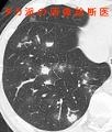 麻疹肺炎　麻疹ウィルス感染症　measles pneumonia