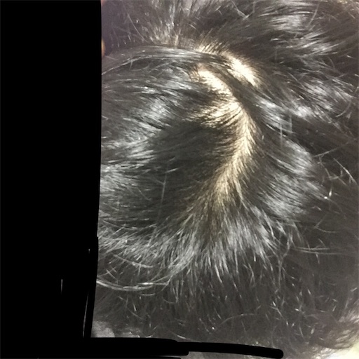 なかなか悪い状態 アホ毛 と眼精疲労 猫背若ハゲ日記 19歳より