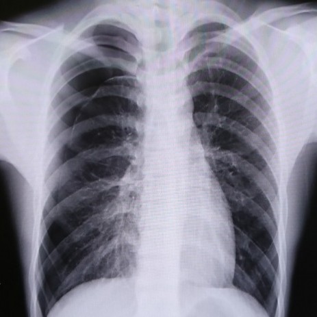 そこの長身・細身のイケメン!お前はこの病気に気をつけろ!【気胸とは】