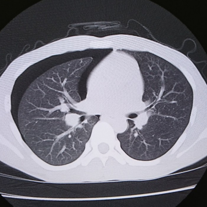 そこの長身・細身のイケメン!お前はこの病気に気をつけろ!【気胸とは】