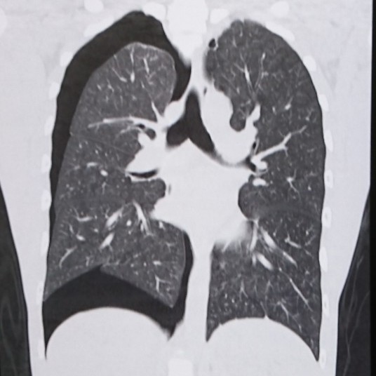 そこの長身・細身のイケメン!お前はこの病気に気をつけろ!【気胸とは】
