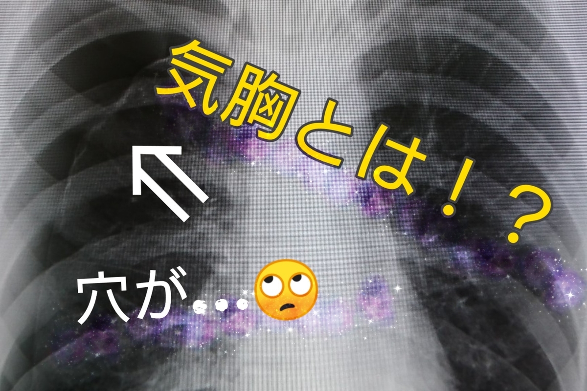 そこの長身・細身のイケメン!お前はこの病気に気をつけろ!【気胸とは】