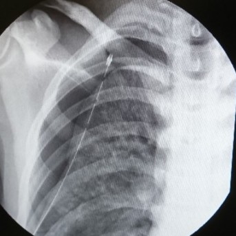 そこの長身・細身のイケメン!お前はこの病気に気をつけろ!【気胸とは】