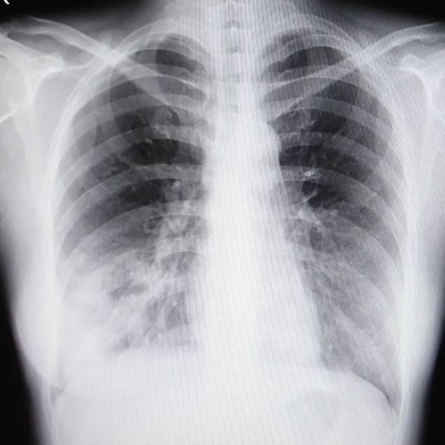 肺炎とは？原因となるものは？レントゲン写真やCTではどう写るの？肺炎球菌ワクチンとは？