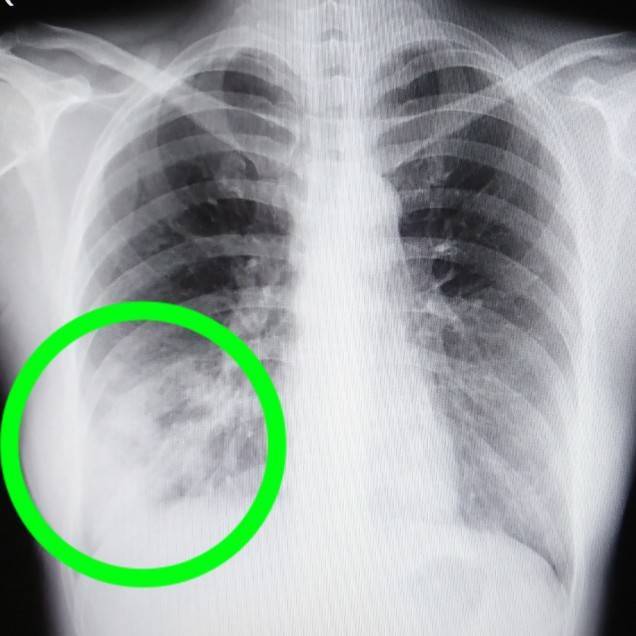 肺炎とは？原因となるものは？レントゲン写真やCTではどう写るの？肺炎球菌ワクチンとは？