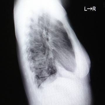 肺炎とは？原因となるものは？レントゲン写真やCTではどう写るの？肺炎球菌ワクチンとは？