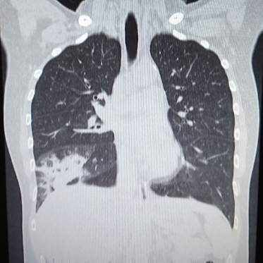 肺炎とは？原因となるものは？レントゲン写真やCTではどう写るの？肺炎球菌ワクチンとは？