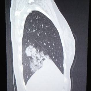 肺炎とは？原因となるものは？レントゲン写真やCTではどう写るの？肺炎球菌ワクチンとは？