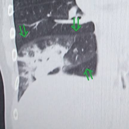 肺炎とは？原因となるものは？レントゲン写真やCTではどう写るの？肺炎球菌ワクチンとは？