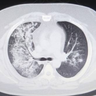 肺炎とは？原因となるものは？レントゲン写真やCTではどう写るの？肺炎球菌ワクチンとは？