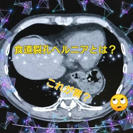 胃が横隔膜から脱出！？食道裂孔ヘルニアとは？ - 診療放射線技師りきりん🦒明日を生きる楽しさスキャン