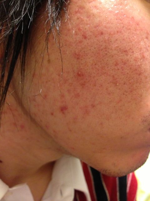 ニキビ アクアチム ディフェリンゲル使用 ６１日目 ゼロ ニキビゼロ運動 ニキビがなくなるまでの道程