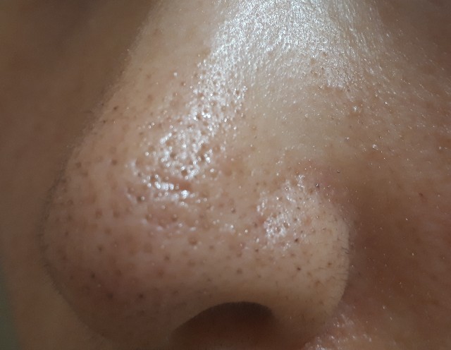毛穴の黒ずみ パック前と後の画像 M子の素肌美人計画