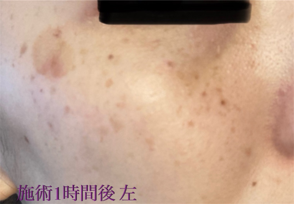 f:id:biyouskin:20211213214501j:image f:id:biyouskin:20211213214501j:image