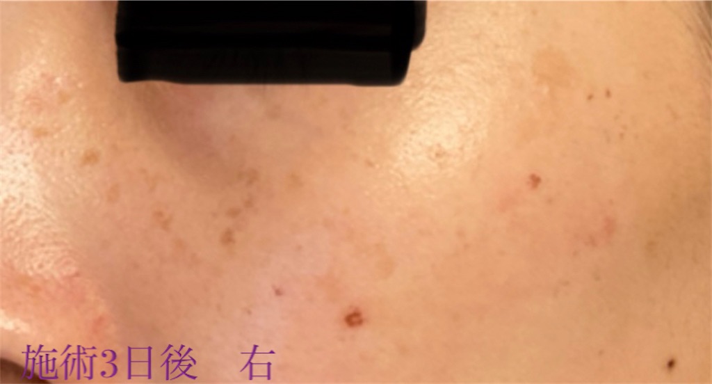 f:id:biyouskin:20211214182531j:image f:id:biyouskin:20211214182531j:image