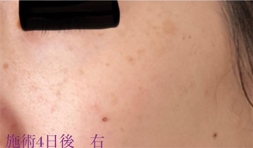 f:id:biyouskin:20211214182915j:image f:id:biyouskin:20211214182915j:image
