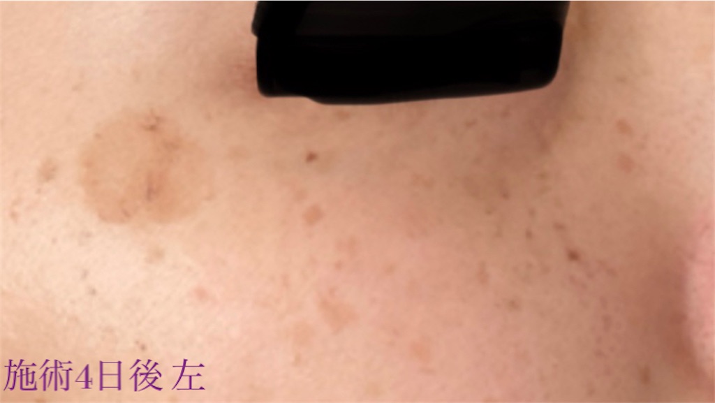 f:id:biyouskin:20211214182917j:image f:id:biyouskin:20211214182917j:image