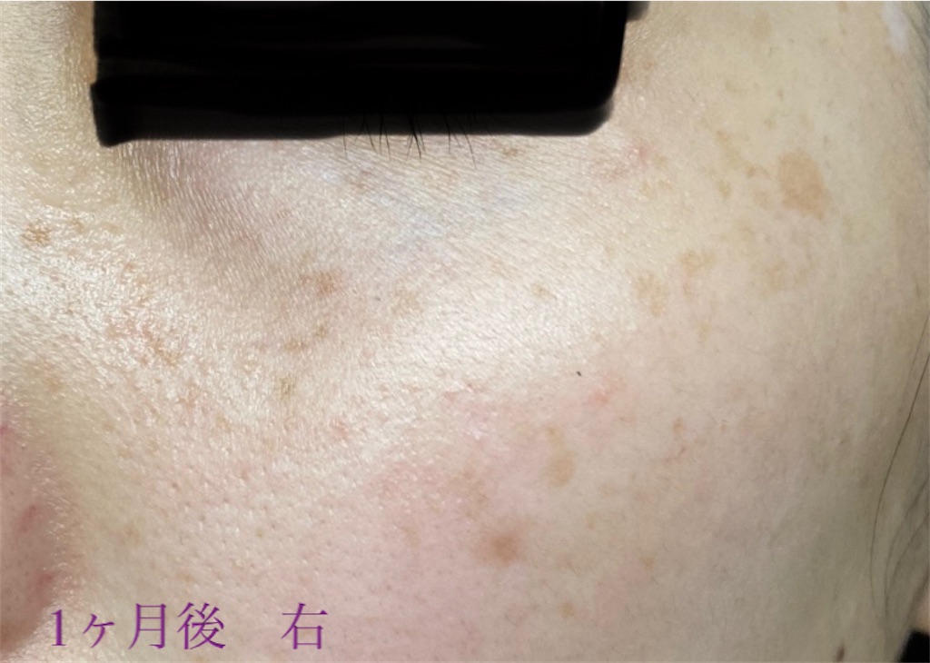 f:id:biyouskin:20211214183734j:image f:id:biyouskin:20211214183734j:image