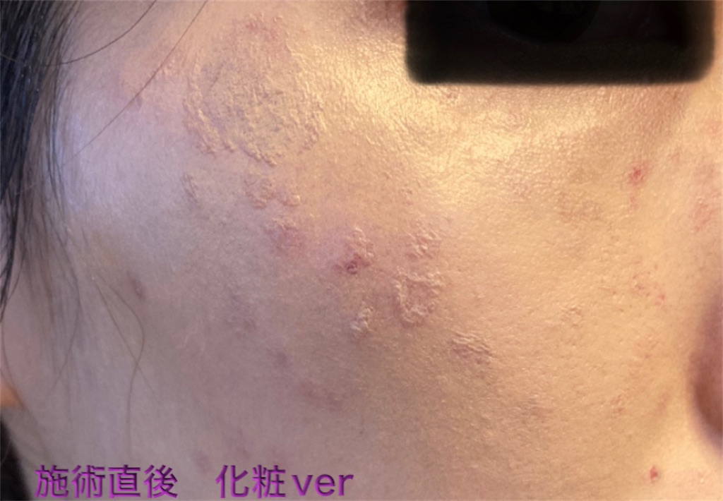 f:id:biyouskin:20211225142833j:image f:id:biyouskin:20211225142833j:image