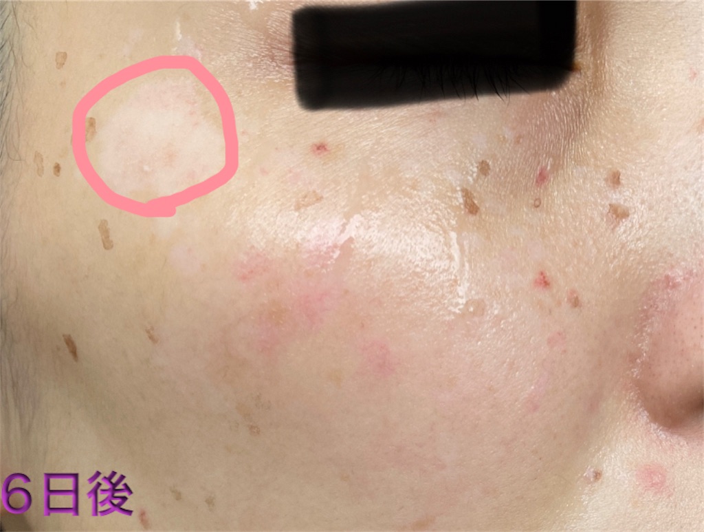 f:id:biyouskin:20211230150555j:image f:id:biyouskin:20211230150555j:image