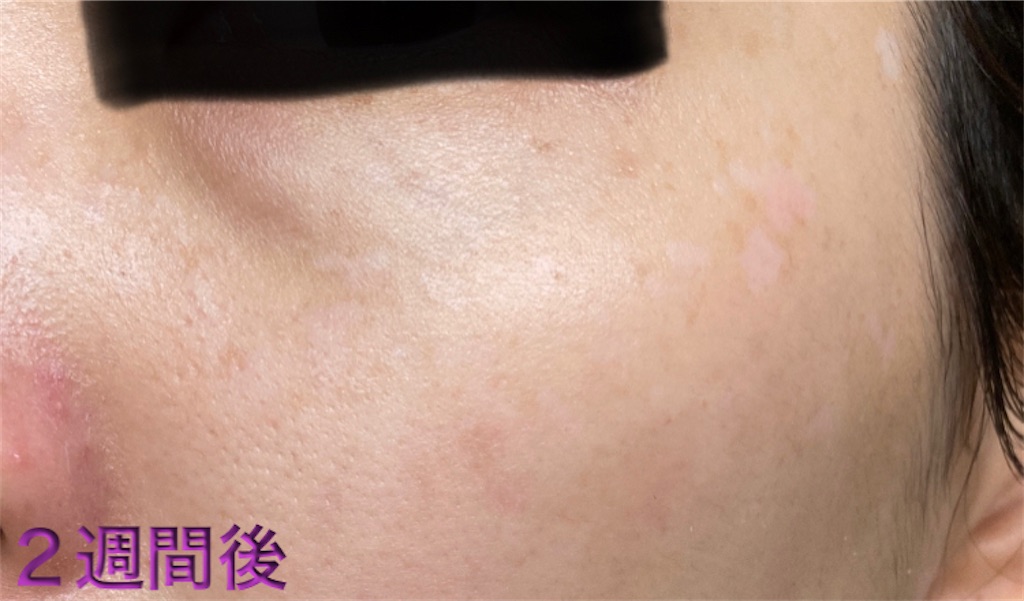 f:id:biyouskin:20220104233625j:image f:id:biyouskin:20220104233625j:image