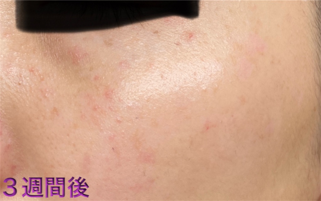 f:id:biyouskin:20220104233642j:image f:id:biyouskin:20220104233642j:image