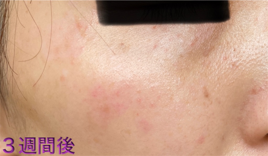 f:id:biyouskin:20220104233645j:image f:id:biyouskin:20220104233645j:image