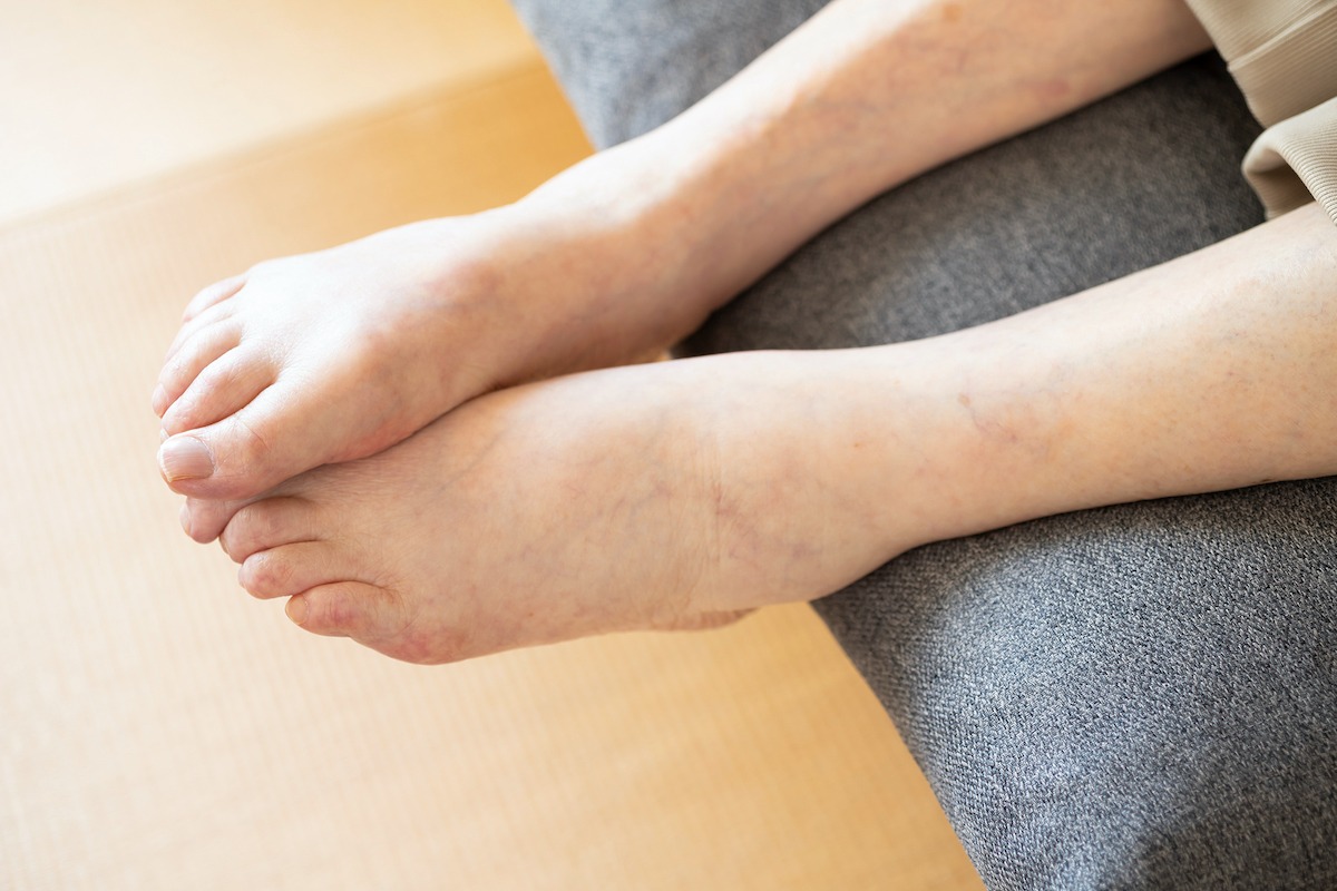 むくみの原因は腎臓にある？ その関係と今すぐできる対策法を解説