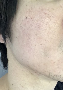 フラクショナルco2レーザー治療5回目結果報告 アラサー男だけどクレーターニキビ跡を治したい フラクショナルco2レーザー治療5回目結果報告 アラサー男だけどクレーターニキビ跡を治したい