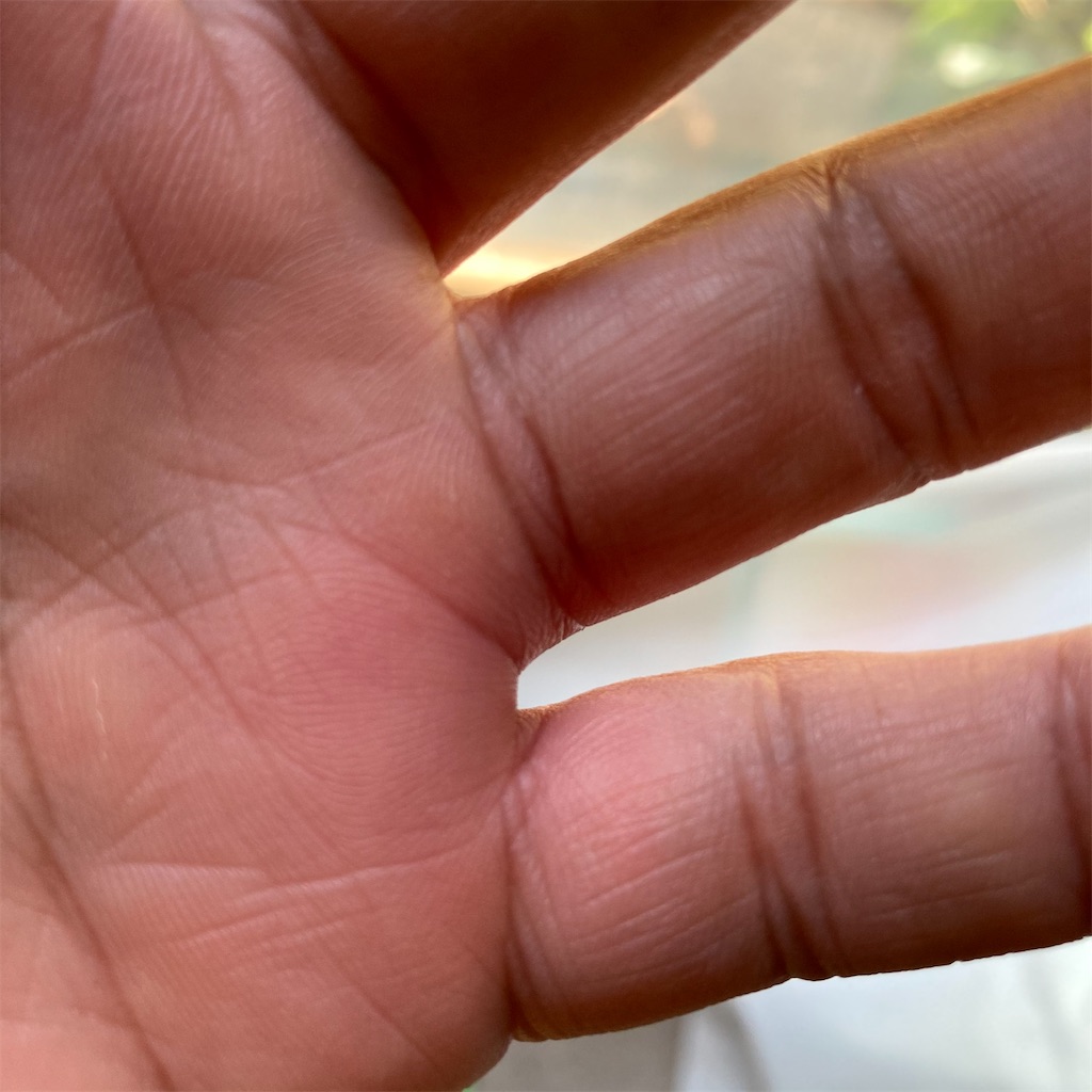 ダニ 指 が 腫れる 一本 だけ | 指が腫れる 病気 一本だけ – UWXOE