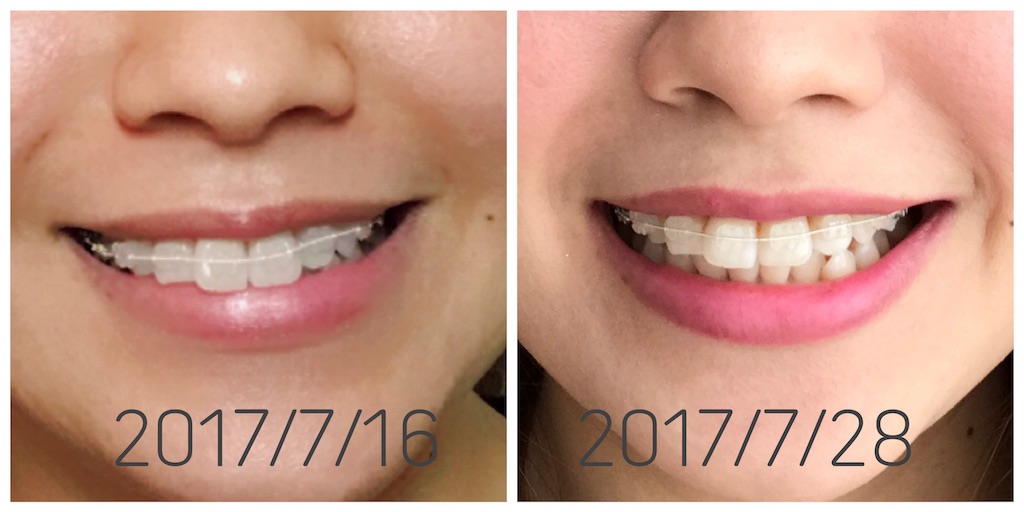 f:id:braces31:20170728204627j:image f:id:braces31:20170728204627j:image