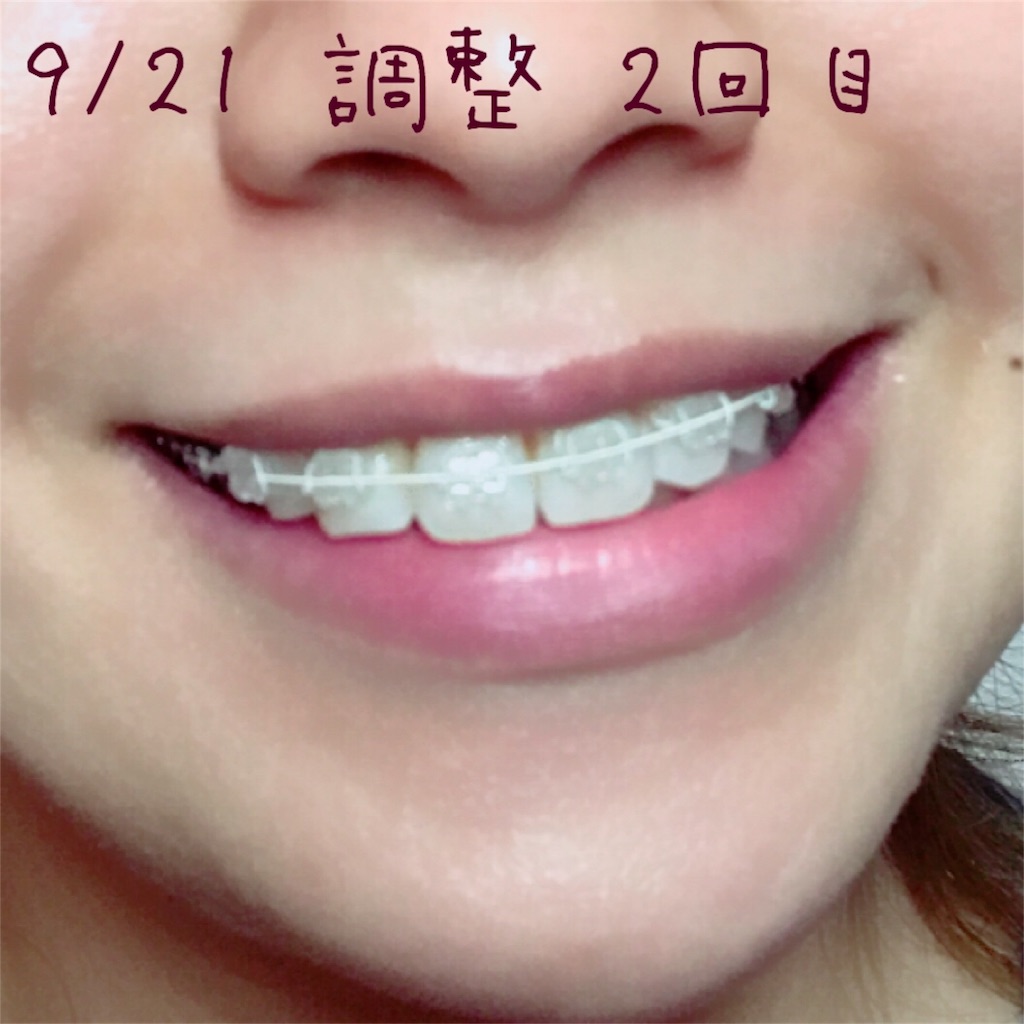 f:id:braces31:20170921225539j:image f:id:braces31:20170921225539j:image