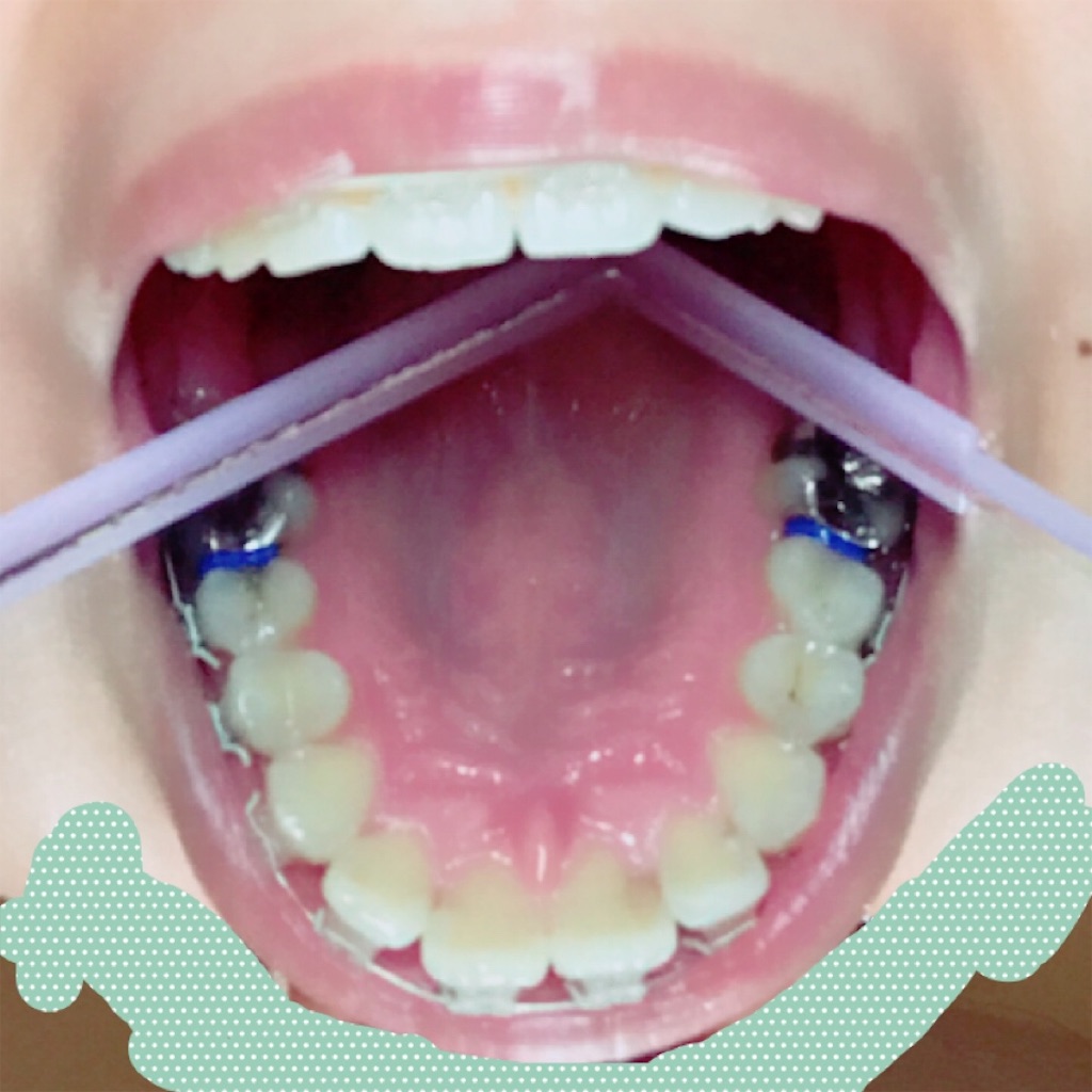 f:id:braces31:20170921225556j:image f:id:braces31:20170921225556j:image