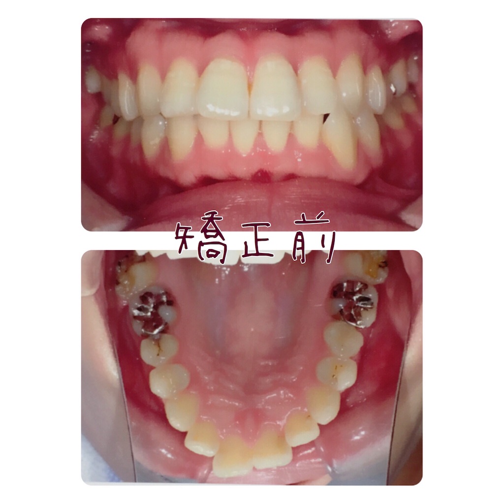f:id:braces31:20170921225836j:image f:id:braces31:20170921225836j:image