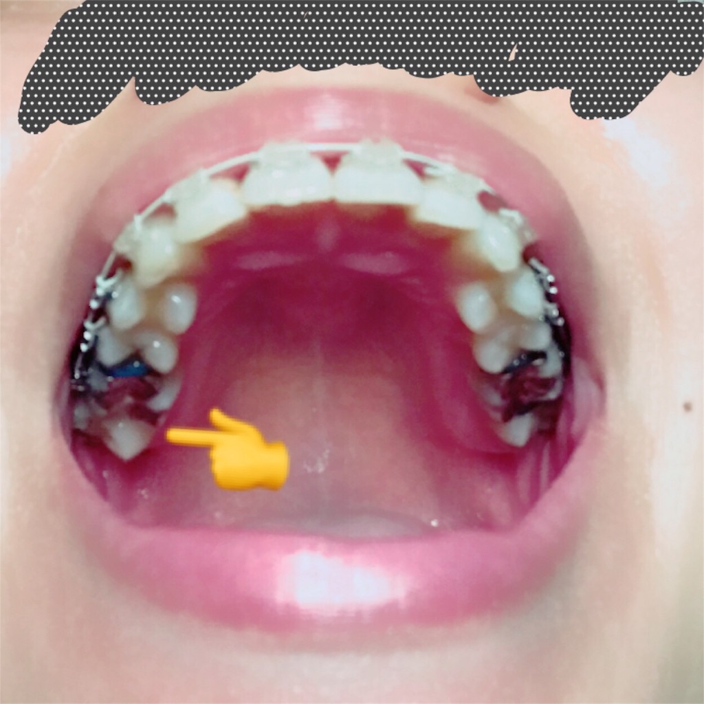 f:id:braces31:20171016232328j:image