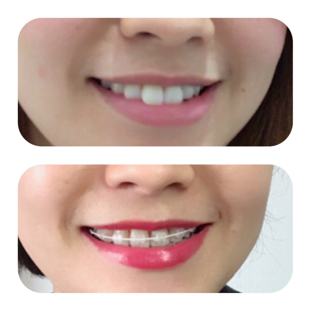 f:id:braces31:20191231125526j:image f:id:braces31:20191231125526j:image