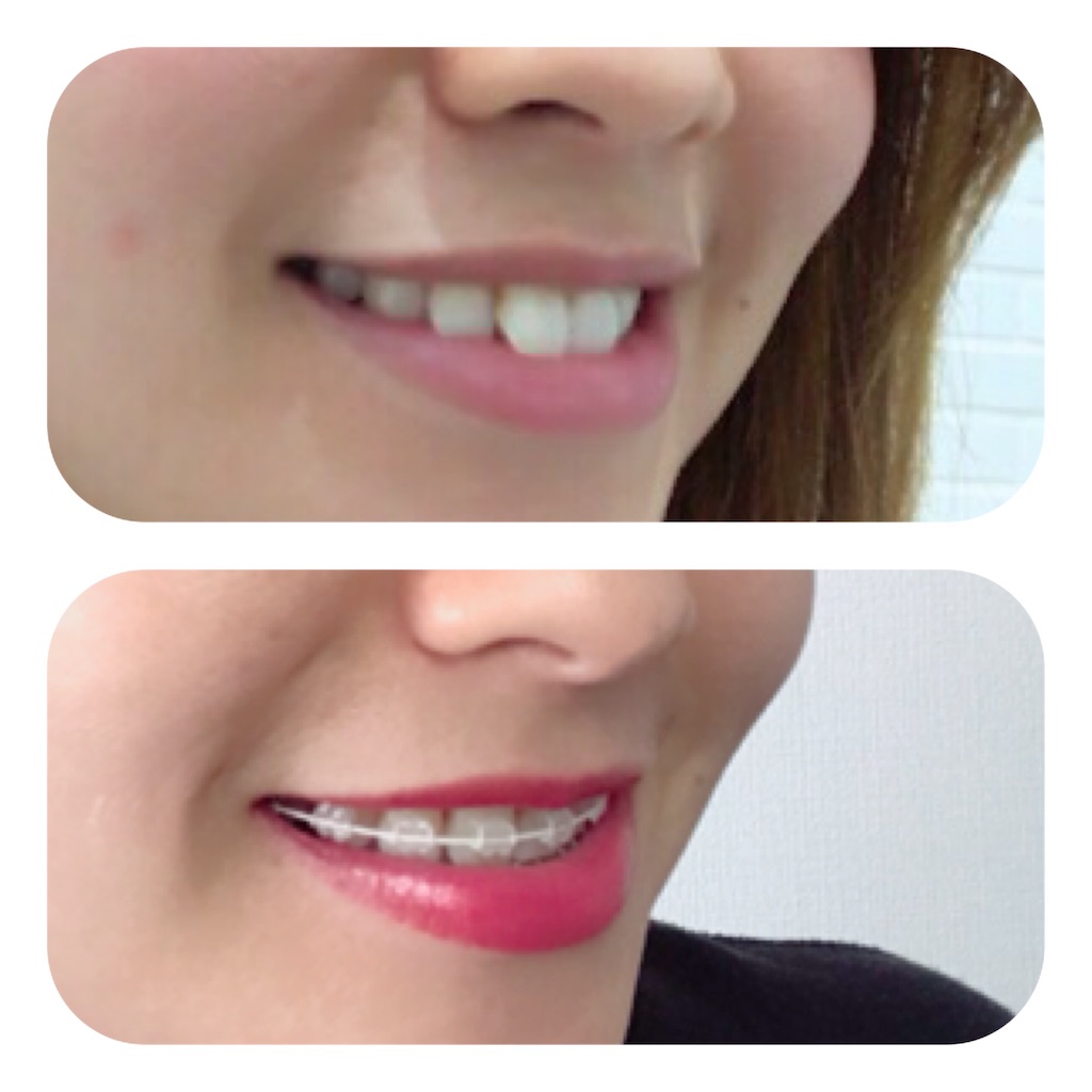 f:id:braces31:20191231125722j:image f:id:braces31:20191231125722j:image