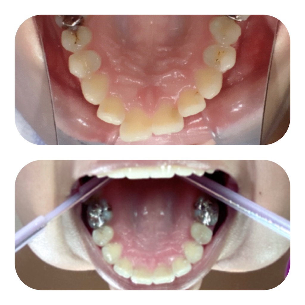 f:id:braces31:20201003214220j:image