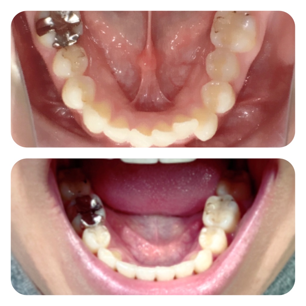 f:id:braces31:20201003214232j:image