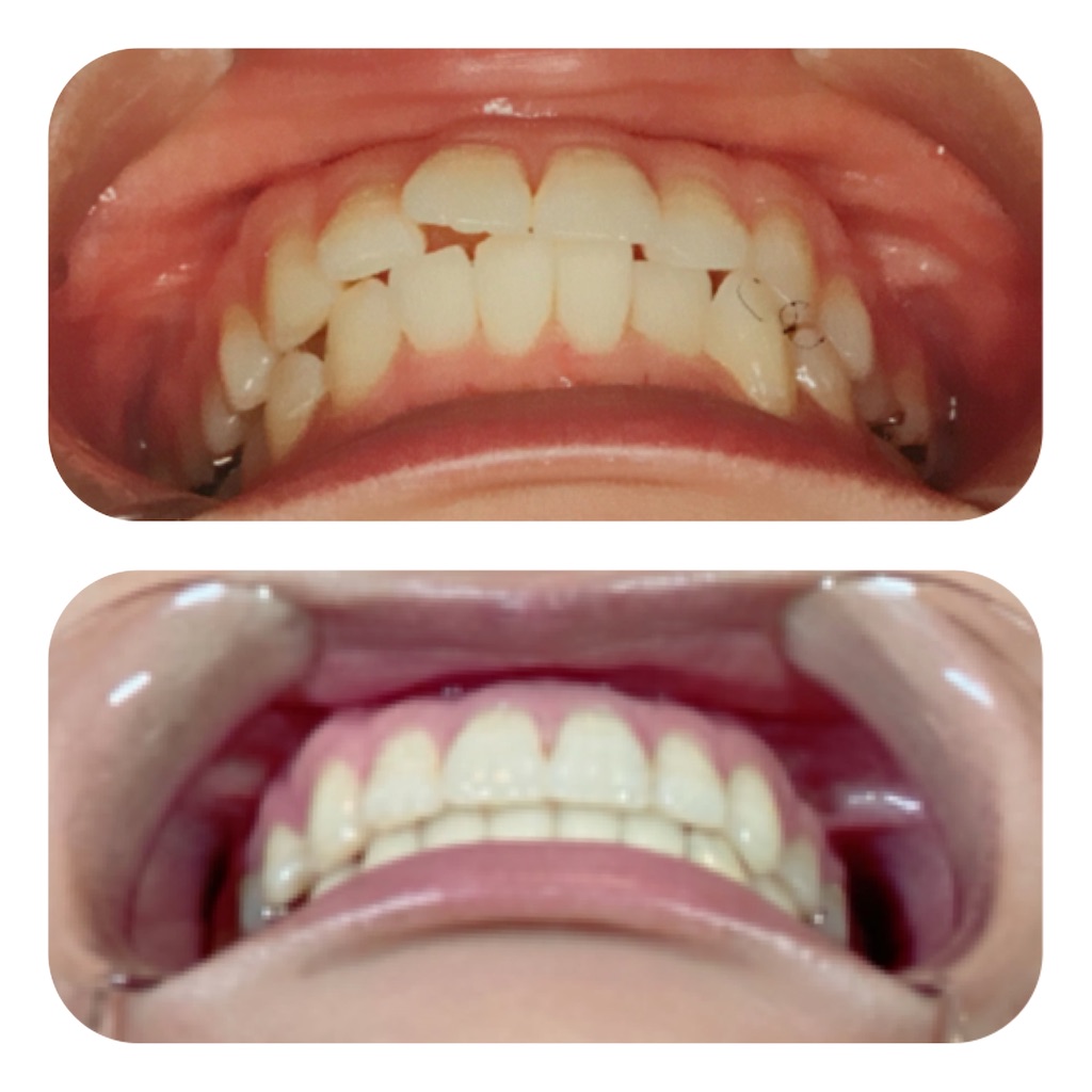 f:id:braces31:20201003214251j:image