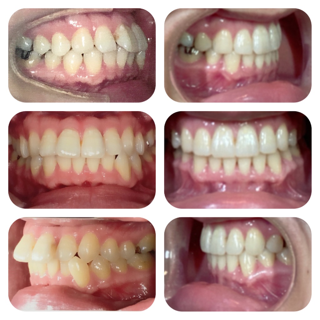 f:id:braces31:20201003214413j:image
