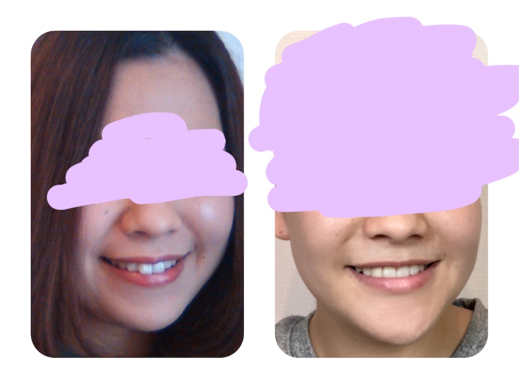 f:id:braces31:20201003214723j:image