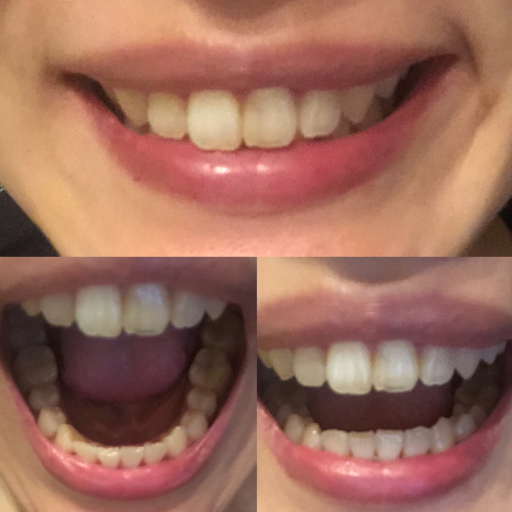 インビザライン 費用