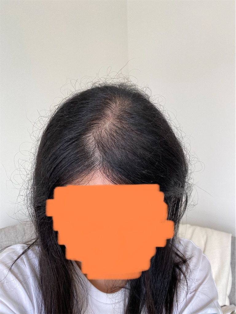 30代女性の薄毛治療ブログ