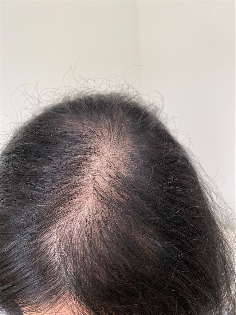 30代女性の薄毛治療ブログ