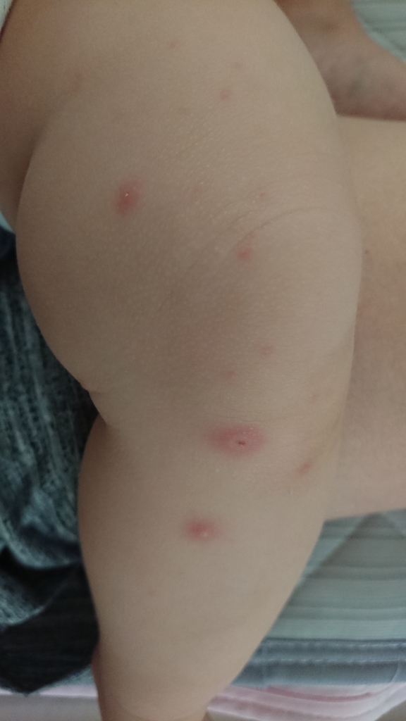 手足口病?ヘルパンギーナ?違いは?赤ちゃん 初めての病気 生後10ヶ月