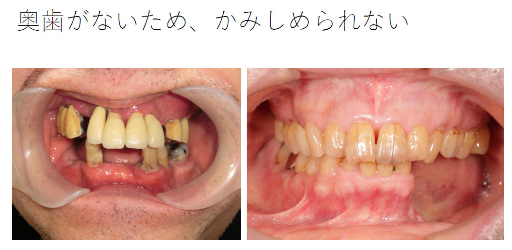 奥歯でかみしめられない